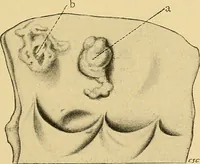 An illustration from A text-book of pathology for students of medicine / by J. George Adami and John McCrae ; illustrated with 304 engravings and 11 colored plates. (1912)