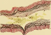 An illustration from A text-book of pathology for students of medicine / by J. George Adami and John McCrae ; illustrated with 304 engravings and 11 colored plates. (1912)