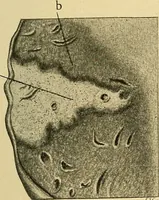 An illustration from A text-book of pathology for students of medicine / by J. George Adami and John McCrae ; illustrated with 304 engravings and 11 colored plates. (1912)