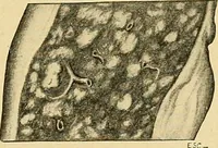 An illustration from A text-book of pathology for students of medicine / by J. George Adami and John McCrae ; illustrated with 304 engravings and 11 colored plates. (1912)