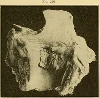 An illustration from A text-book of pathology for students of medicine / by J. George Adami and John McCrae ; illustrated with 304 engravings and 11 colored plates. (1912)