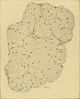 An illustration from A text-book of pathology for students of medicine / by J. George Adami and John McCrae ; illustrated with 304 engravings and 11 colored plates. (1912)