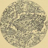 An illustration from A text-book of pathology for students of medicine / by J. George Adami and John McCrae ; illustrated with 304 engravings and 11 colored plates. (1912)