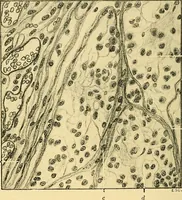 An illustration from A text-book of pathology for students of medicine / by J. George Adami and John McCrae ; illustrated with 304 engravings and 11 colored plates. (1912)
