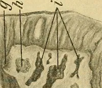 An illustration from A text-book of pathology for students of medicine / by J. George Adami and John McCrae ; illustrated with 304 engravings and 11 colored plates. (1912)