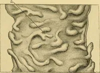 An illustration from A text-book of pathology for students of medicine / by J. George Adami and John McCrae ; illustrated with 304 engravings and 11 colored plates. (1912)