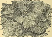 An illustration from A text-book of pathology for students of medicine / by J. George Adami and John McCrae ; illustrated with 304 engravings and 11 colored plates. (1912)