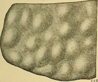 An illustration from A text-book of pathology for students of medicine / by J. George Adami and John McCrae ; illustrated with 304 engravings and 11 colored plates. (1912)