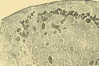 An illustration from A text-book of pathology for students of medicine / by J. George Adami and John McCrae ; illustrated with 304 engravings and 11 colored plates. (1912)