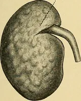 An illustration from A text-book of pathology for students of medicine / by J. George Adami and John McCrae ; illustrated with 304 engravings and 11 colored plates. (1912)