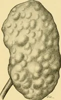 An illustration from A text-book of pathology for students of medicine / by J. George Adami and John McCrae ; illustrated with 304 engravings and 11 colored plates. (1912)