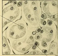 An illustration from A text-book of pathology for students of medicine / by J. George Adami and John McCrae ; illustrated with 304 engravings and 11 colored plates. (1912)