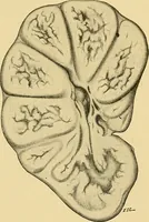 An illustration from A text-book of pathology for students of medicine / by J. George Adami and John McCrae ; illustrated with 304 engravings and 11 colored plates. (1912)