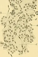 An illustration from A text-book of pathology for students of medicine / by J. George Adami and John McCrae ; illustrated with 304 engravings and 11 colored plates. (1912)