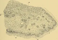 An illustration from A text-book of pathology for students of medicine / by J. George Adami and John McCrae ; illustrated with 304 engravings and 11 colored plates. (1912)