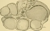 An illustration from A text-book of pathology for students of medicine / by J. George Adami and John McCrae ; illustrated with 304 engravings and 11 colored plates. (1912)
