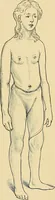 An illustration from A text-book of pathology for students of medicine / by J. George Adami and John McCrae ; illustrated with 304 engravings and 11 colored plates. (1912)