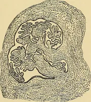An illustration from A text-book of pathology for students of medicine / by J. George Adami and John McCrae ; illustrated with 304 engravings and 11 colored plates. (1912)