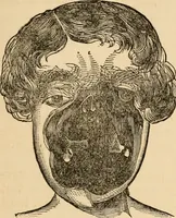 An illustration from The household physician : for the use of families, planters, seamen, and travellers ; being a brief description, in plain language, of all the diseases of men, women, and children, with the newest and most approved methods of curing them / by Ira Warren. (1866)