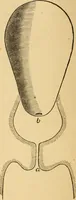 An illustration from The household physician : for the use of families, planters, seamen, and travellers ; being a brief description, in plain language, of all the diseases of men, women, and children, with the newest and most approved methods of curing them / by Ira Warren. (1866)