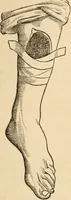 An illustration from The household physician : for the use of families, planters, seamen, and travellers ; being a brief description, in plain language, of all the diseases of men, women, and children, with the newest and most approved methods of curing them / by Ira Warren. (1866)