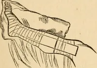 An illustration from The household physician : for the use of families, planters, seamen, and travellers ; being a brief description, in plain language, of all the diseases of men, women, and children, with the newest and most approved methods of curing them / by Ira Warren. (1866)