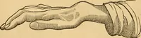 An illustration from The household physician : for the use of families, planters, seamen, and travellers ; being a brief description, in plain language, of all the diseases of men, women, and children, with the newest and most approved methods of curing them / by Ira Warren. (1866)