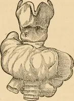 An illustration from The household physician : for the use of families, planters, seamen, and travellers ; being a brief description, in plain language, of all the diseases of men, women, and children, with the newest and most approved methods of curing them / by Ira Warren. (1866)