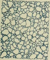 An illustration from Atlas and text-book of dentistry including diseases of the mouth / by Gustav Preiswerk. Edited by George W. Warren. (1906)