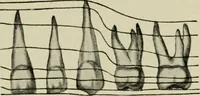 An illustration from Atlas and text-book of dentistry including diseases of the mouth / by Gustav Preiswerk. Edited by George W. Warren. (1906)
