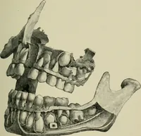 An illustration from Atlas and text-book of dentistry including diseases of the mouth / by Gustav Preiswerk. Edited by George W. Warren. (1906)