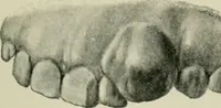 An illustration from Atlas and text-book of dentistry including diseases of the mouth / by Gustav Preiswerk. Edited by George W. Warren. (1906)