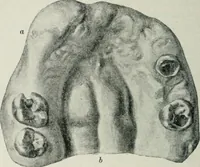 An illustration from Atlas and text-book of dentistry including diseases of the mouth / by Gustav Preiswerk. Edited by George W. Warren. (1906)