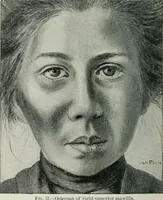 An illustration from Atlas and text-book of dentistry including diseases of the mouth / by Gustav Preiswerk. Edited by George W. Warren. (1906)