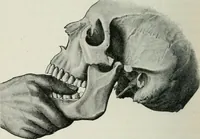 An illustration from Atlas and text-book of dentistry including diseases of the mouth / by Gustav Preiswerk. Edited by George W. Warren. (1906)