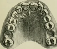 An illustration from Atlas and text-book of dentistry including diseases of the mouth / by Gustav Preiswerk. Edited by George W. Warren. (1906)