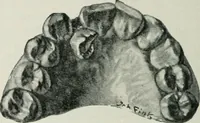 An illustration from Atlas and text-book of dentistry including diseases of the mouth / by Gustav Preiswerk. Edited by George W. Warren. (1906)