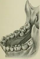 An illustration from Atlas and text-book of dentistry including diseases of the mouth / by Gustav Preiswerk. Edited by George W. Warren. (1906)
