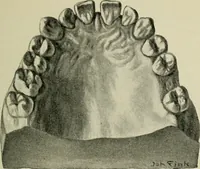 An illustration from Atlas and text-book of dentistry including diseases of the mouth / by Gustav Preiswerk. Edited by George W. Warren. (1906)