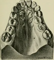 An illustration from Atlas and text-book of dentistry including diseases of the mouth / by Gustav Preiswerk. Edited by George W. Warren. (1906)