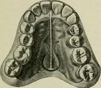 An illustration from Atlas and text-book of dentistry including diseases of the mouth / by Gustav Preiswerk. Edited by George W. Warren. (1906)