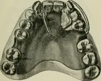 An illustration from Atlas and text-book of dentistry including diseases of the mouth / by Gustav Preiswerk. Edited by George W. Warren. (1906)