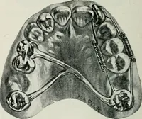 An illustration from Atlas and text-book of dentistry including diseases of the mouth / by Gustav Preiswerk. Edited by George W. Warren. (1906)