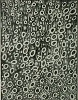 An illustration from Atlas and text-book of dentistry including diseases of the mouth / by Gustav Preiswerk. Edited by George W. Warren. (1906)