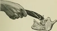 An illustration from Atlas and text-book of dentistry including diseases of the mouth / by Gustav Preiswerk. Edited by George W. Warren. (1906)