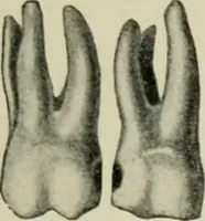 An illustration from Atlas and text-book of dentistry including diseases of the mouth / by Gustav Preiswerk. Edited by George W. Warren. (1906)