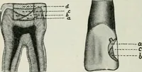 An illustration from Atlas and text-book of dentistry including diseases of the mouth / by Gustav Preiswerk. Edited by George W. Warren. (1906)