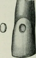 An illustration from Atlas and text-book of dentistry including diseases of the mouth / by Gustav Preiswerk. Edited by George W. Warren. (1906)