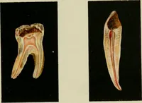 An illustration from Atlas and text-book of dentistry including diseases of the mouth / by Gustav Preiswerk. Edited by George W. Warren. (1906)