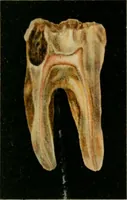 An illustration from Atlas and text-book of dentistry including diseases of the mouth / by Gustav Preiswerk. Edited by George W. Warren. (1906)